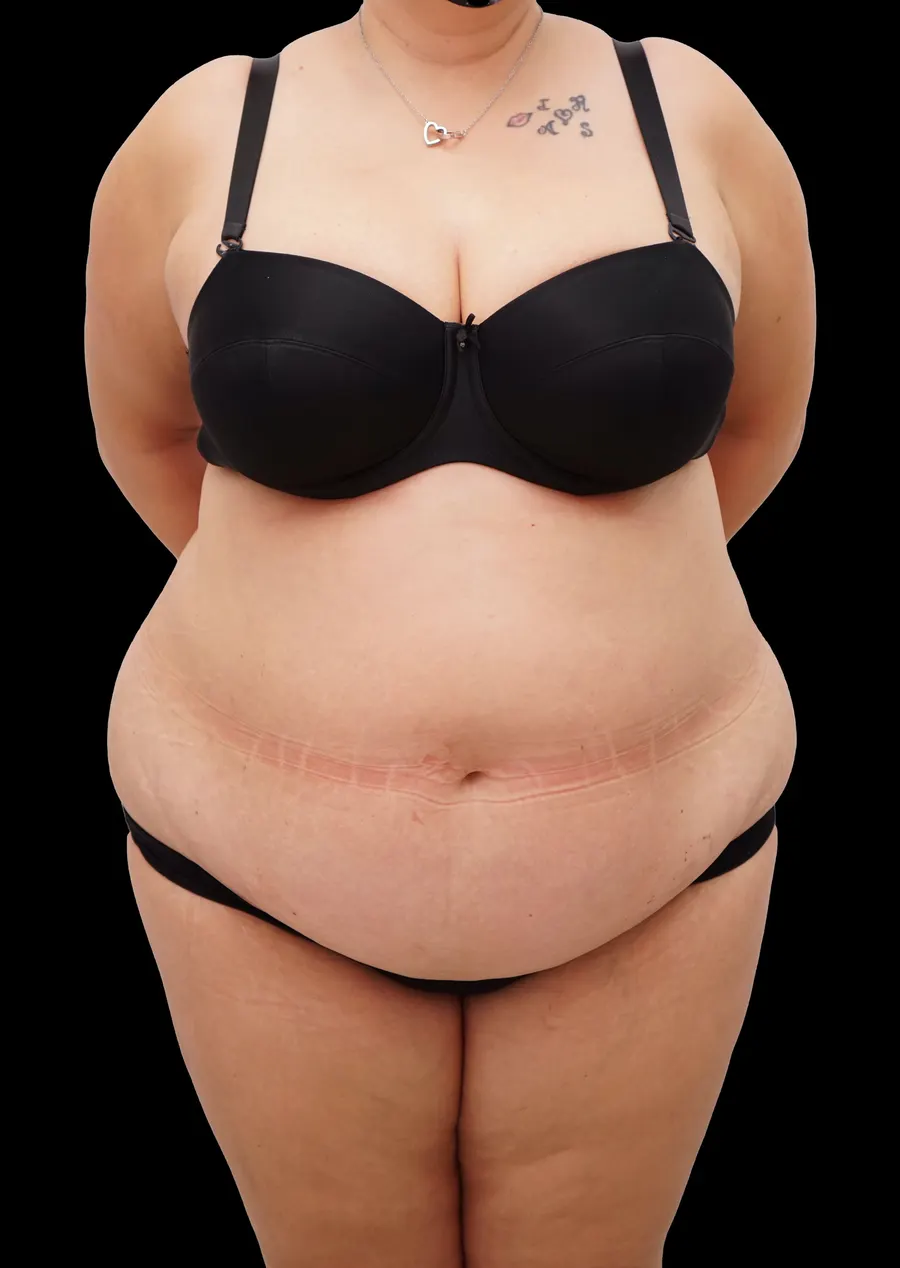 Abdominoplastia: antes de la intervención