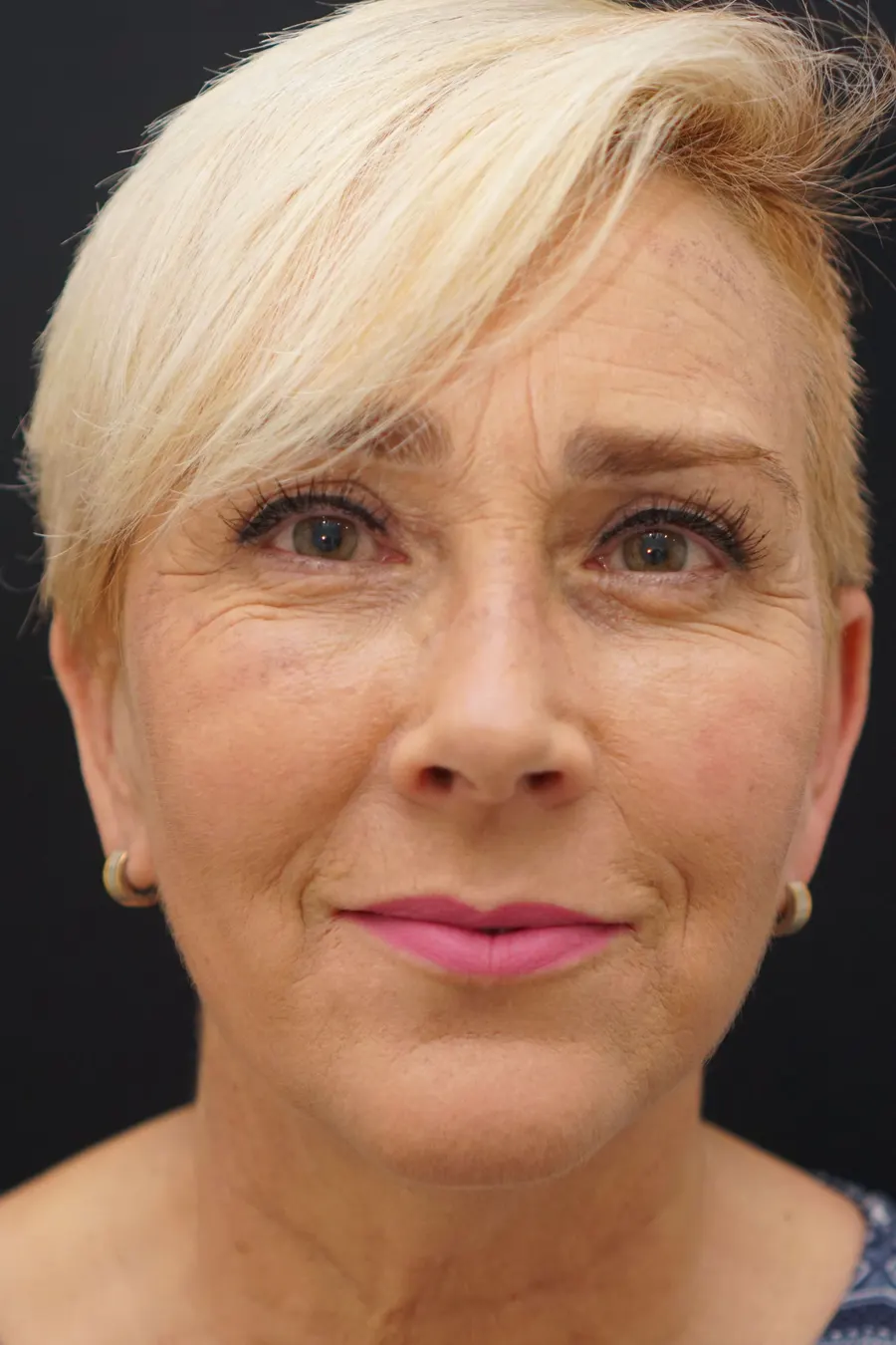 Blefaroplastia: resultado tras la intervención