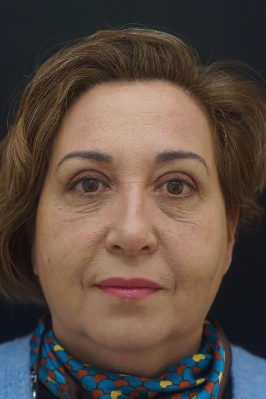 Blefaroplastia: resultado tras la intervención