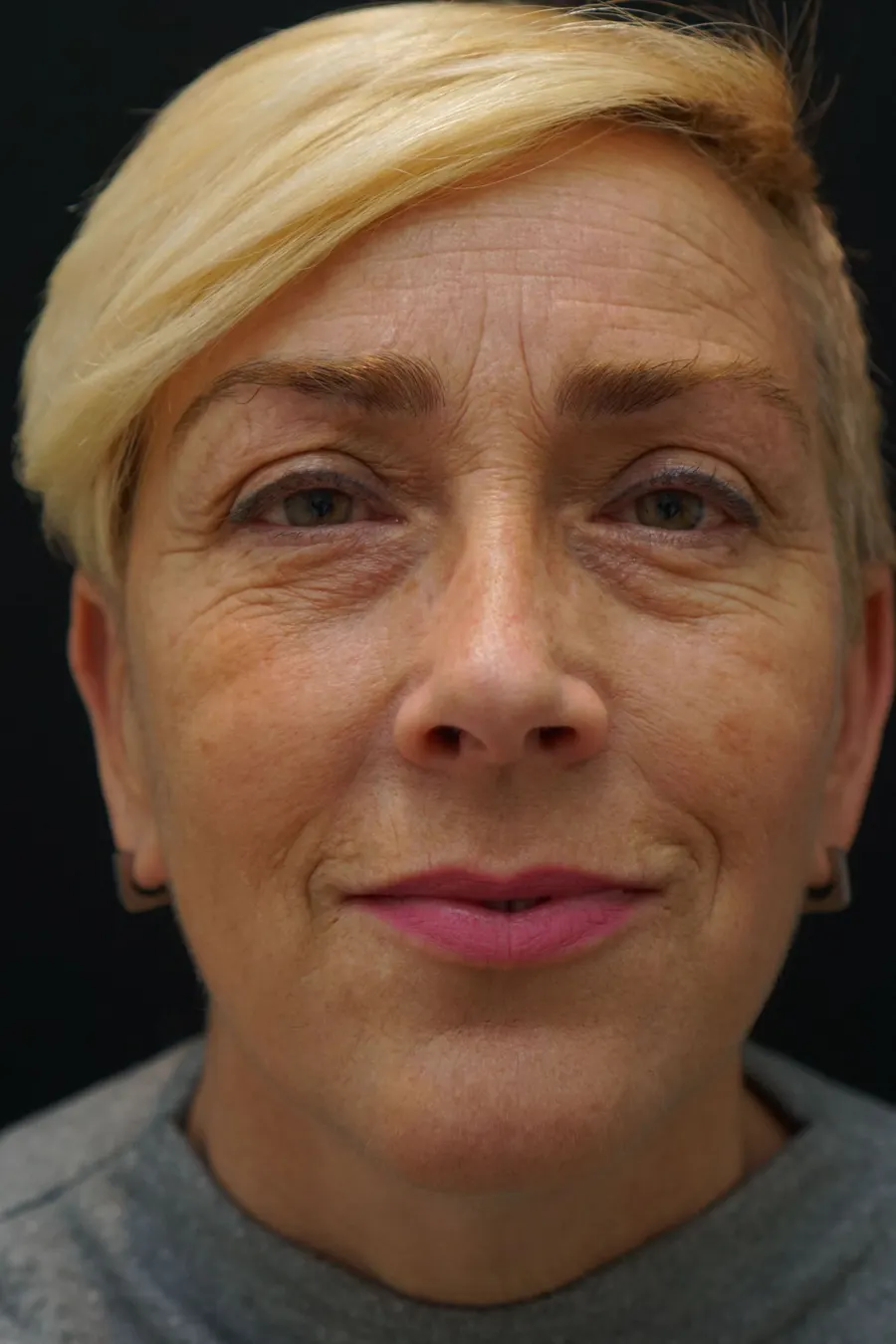 Blefaroplastia: antes de la intervención