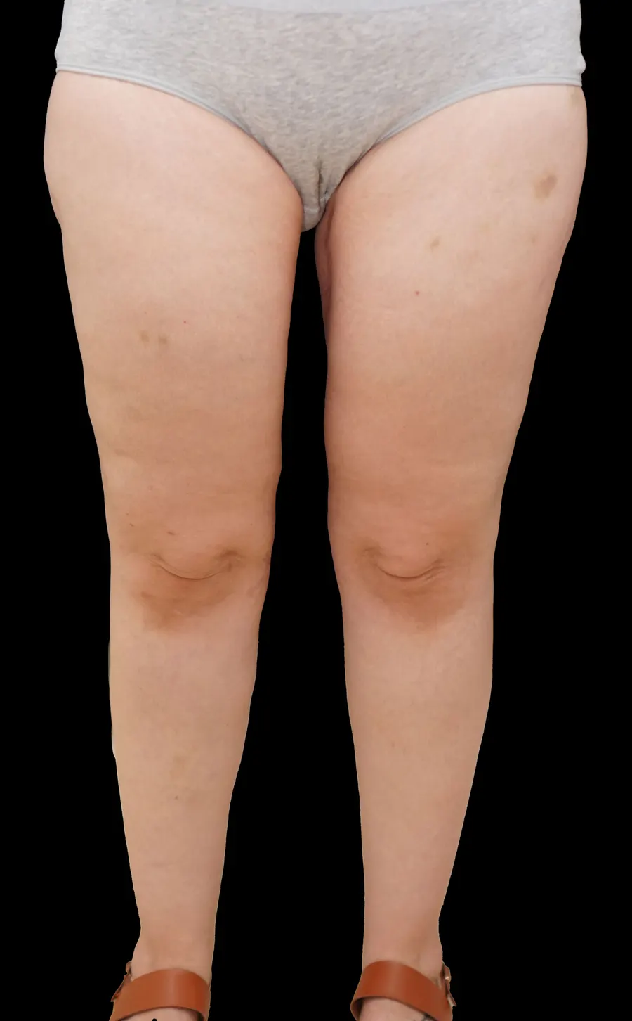 Cirugía secuelas de la obesidad: resultado tras la intervención