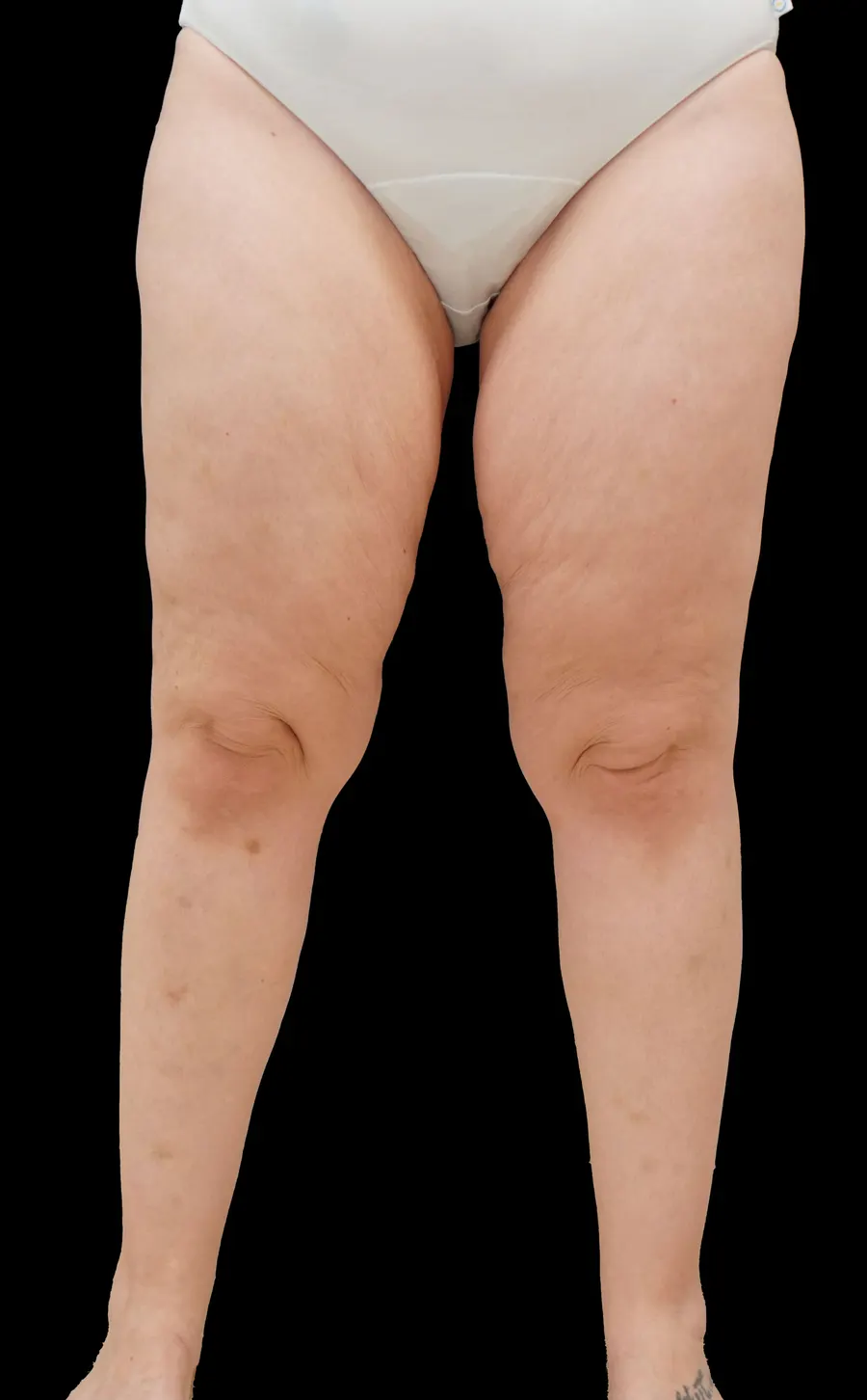 Cirugía secuelas de la obesidad: antes de la intervención