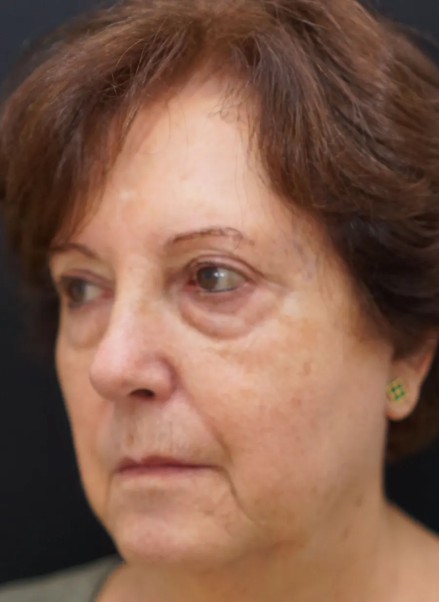 Lipofilling facial: antes de la intervención