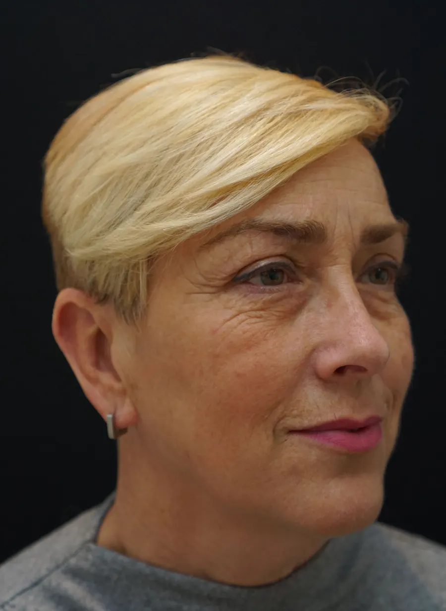 Lipofilling facial: antes de la intervención