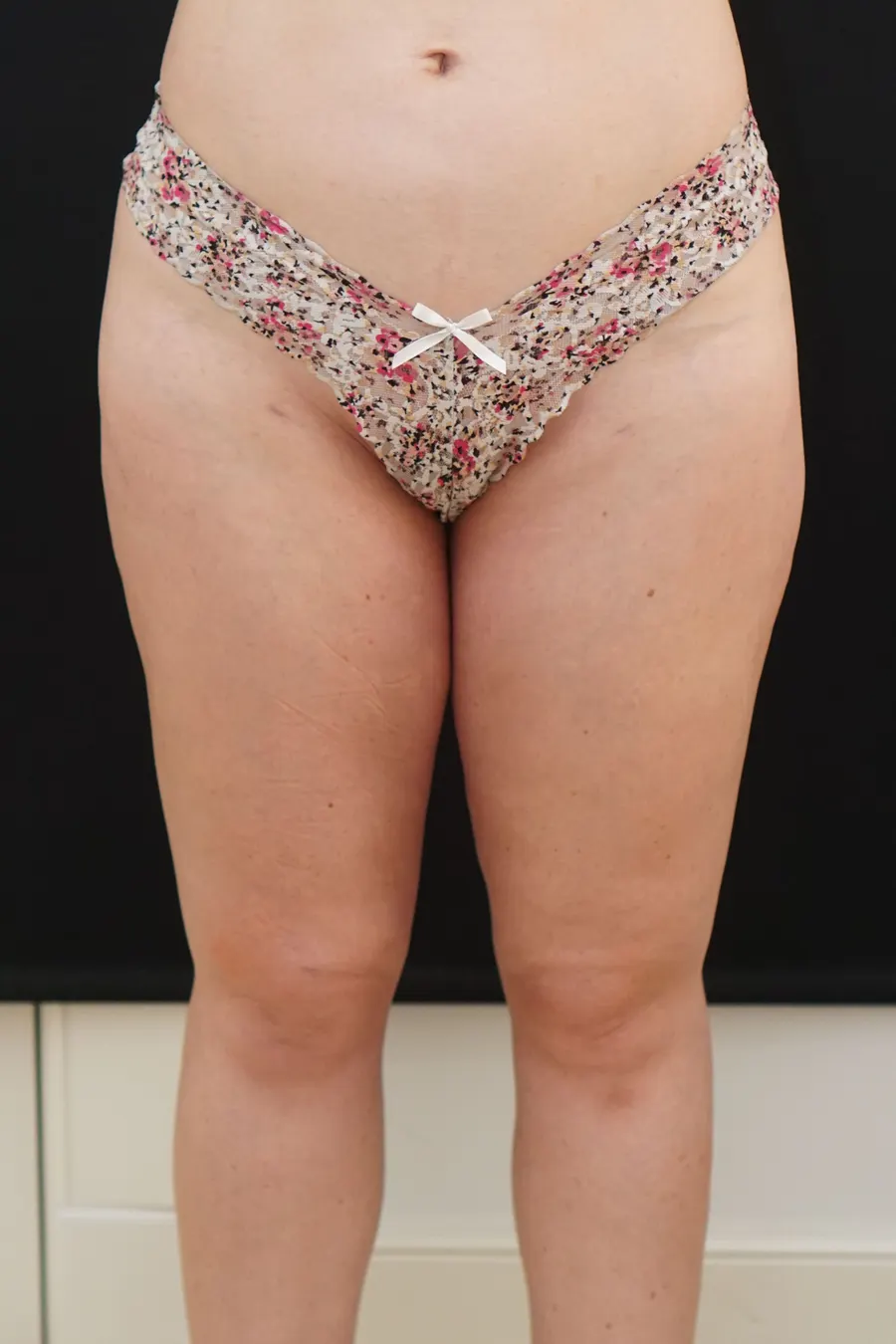 Liposucción o lipoescultura: resultado tras la intervención