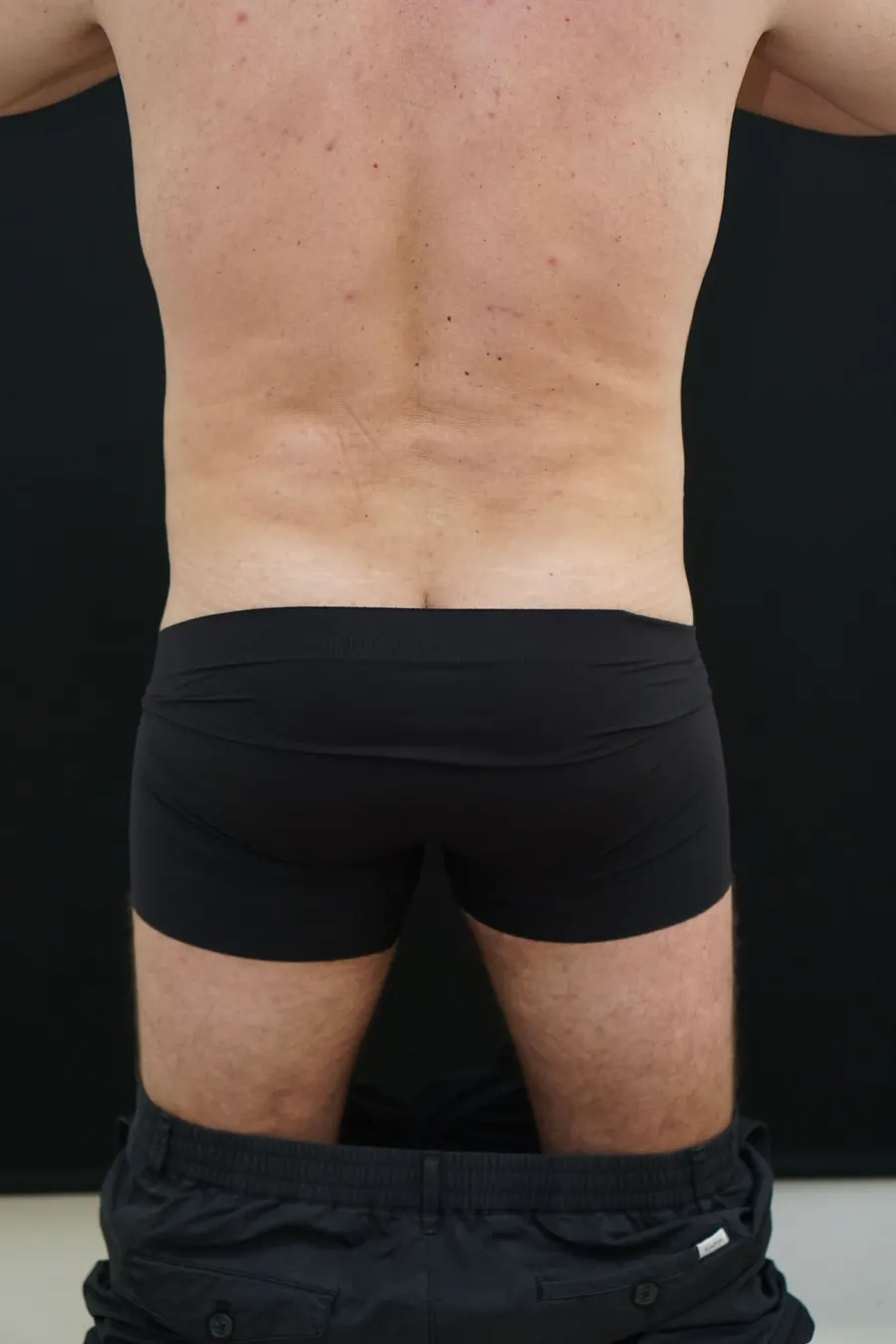 Liposucción o lipoescultura: resultado tras la intervención