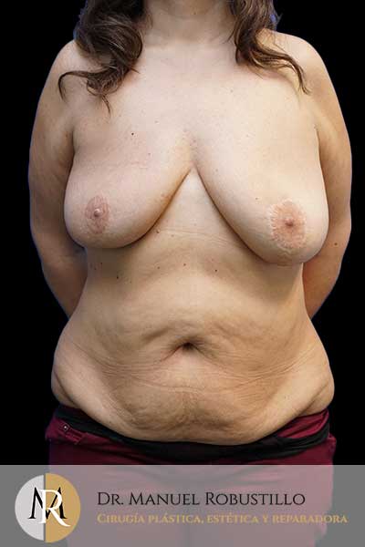 Antes