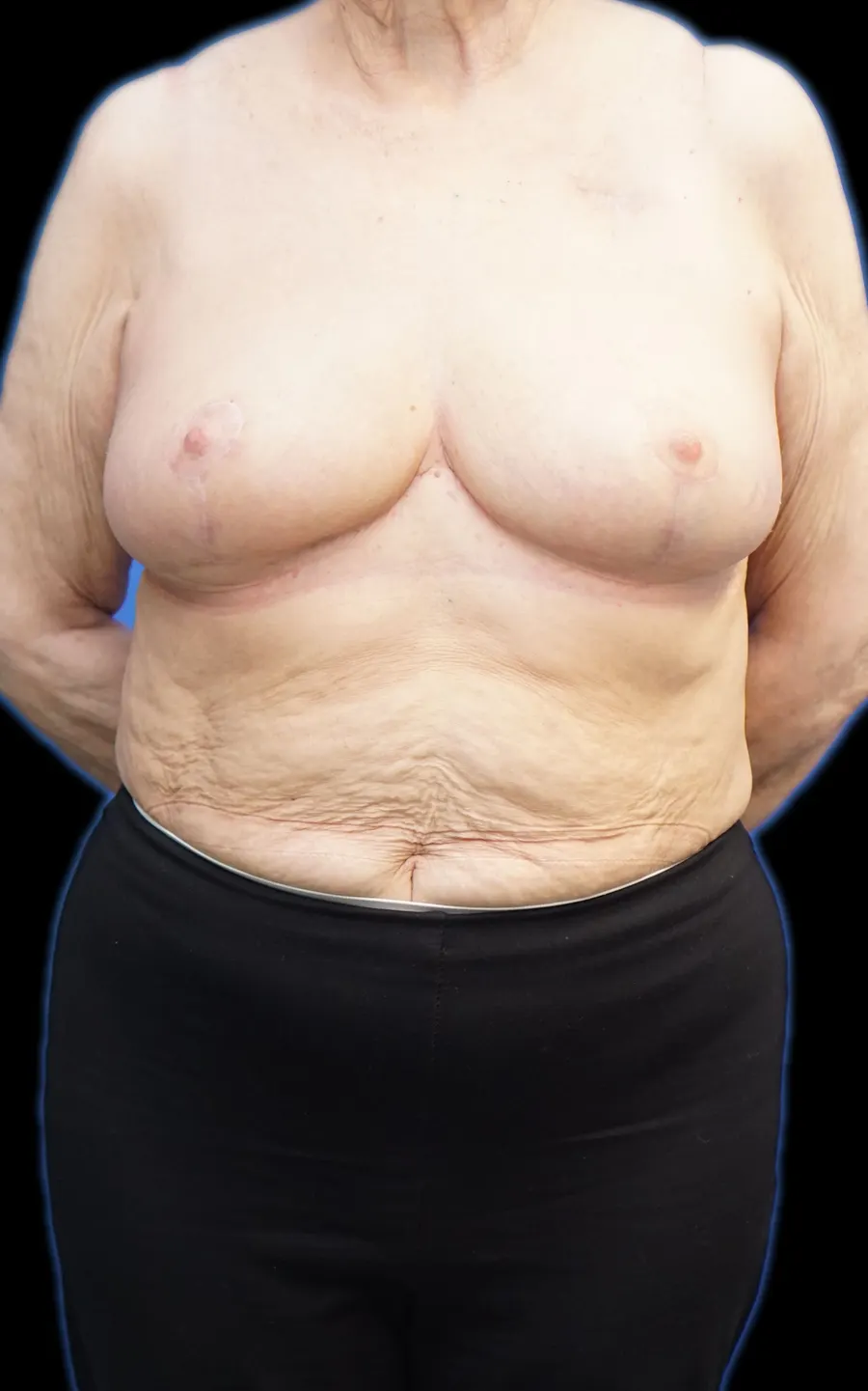 Simetrización / oncoplastia: resultado tras la intervención